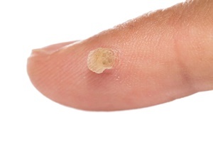 Wart - skin condition, which effectively fight against Skincell Pro